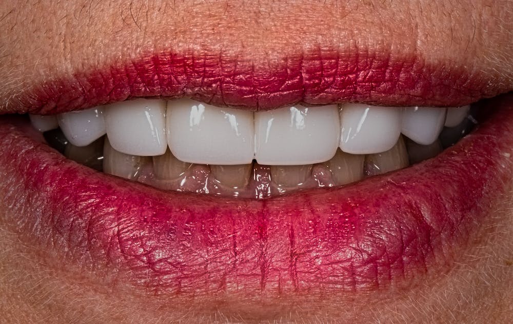 Dentme by Dr. Andrea - zubná mabulancia - pred a po výsledky