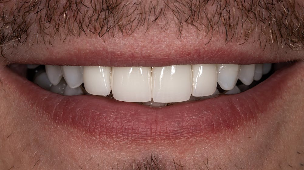 Dentme by Dr. Andrea - zubná mabulancia - pred a po výsledky